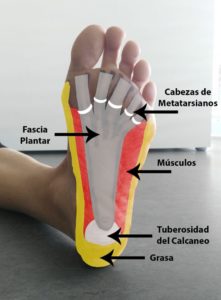 FASCITIS   PLANTAR